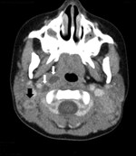 Thumbnail of Computed tomography scan of the neck of a 3-year-old girl, showing right lateral retropharyngeal abscess (white arrows) and enlarged bilateral posterior cervical lymph nodes with low attenuation of a right cervical lymph node (black arrow), consistent with atypical mycobacterium adenitis.