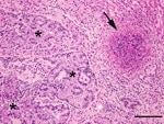 Thumbnail of Liver from a juvenile wild rabbit with numerous oval Eimeria stiedae oocysts in the convoluted hyperplastic bile ducts (asterisks) and necrotizing hepatitis (arrow) by Francisella tularensis. Hematoxylin and eosin stain; scale bar = 200 µm.