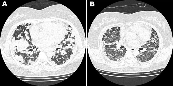 Chest computed tomography scan of a 40-year-old woman with no history of systemic disease. A) Bilateral multiple lung nodules and lymphomatoid granulomatosis were diagnosed after lung biopsy. B) After rituximab treatment, the prior nodular lung lesions decreased dramatically, but newly developed interstitial ground glass opacities appeared.