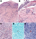 Thumbnail of Histologic appearance of the cutaneous lesion of a man with blastomycosis. Ulcerated epidermis (A) showing superficial and deep perivascular infiltrates, predominantly mononuclear inflammatory cells. Fibrinopurulent exudate (B) adjacent to the ulcer, comprising neutrophils, erythrocytes, and necrotic cellular debris (C), and occasional large yeasts morphologically compatible with Blastomyces dermatitidis infection (D and E). Hematoxylin and eosin stain (A, B, and C), Grocott methena