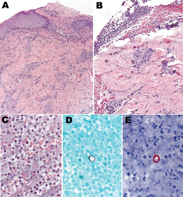 Histologic appearance of the cutaneous lesion of a man with blastomycosis. Ulcerated epidermis (A) showing superficial and deep perivascular infiltrates, predominantly mononuclear inflammatory cells. Fibrinopurulent exudate (B) adjacent to the ulcer, comprising neutrophils, erythrocytes, and necrotic cellular debris (C), and occasional large yeasts morphologically compatible with Blastomyces dermatitidis infection (D and E). Hematoxylin and eosin stain (A, B, and C), Grocott methenamine silver s