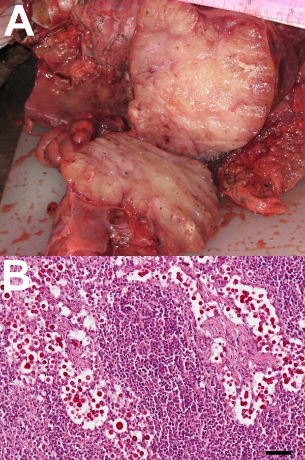 A. A) Enlarged mediastinal lymph nodes of a stranded, pregnant, harbor porpoise (Phocoena phocoena) infected with Cryptococcus gattii that was transmitted to its fetus. B) Mucicarmine–stained sections of fetal mediastinal lymph node, showing C. gattii extracellular yeast aggregates (original magnification ×20). Scale bar = 50 μm.