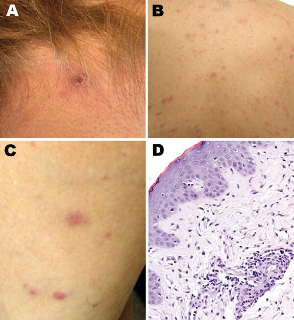 Cutaneous lesions of patients with suspected and confirmed Rickettsia parkeri rickettsiosis in Argentina. A) Eschar at the nape of the neck at the site of recent tick bite. B, C) Papulovesicular rash involving the back and lower extremities. D) Histopathologic appearance of a papule biopsy specimen, showing perivascular mononuclear inflammatory cell infiltrates and edema of the adjacent superficial dermis and an intact epidermis (hematoxylin and eosin stain; original magnification ×100).