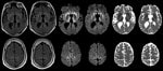 Thumbnail of Maps showing axial fluid attenuated inversion recovery (FLAIR), diffusion-weighted imaging (DWI), and apparent diffusion coefficient (ADC) at the level of the basal nuclei (top row) and dorsal frontoparietal cortex (bottom row) of the brain of a 33.8-year-old man with agenesis of the corpus callosum, schizencephaly, and heterotopia. Note the symmetrical DWI signal hyperintensities in the striatum and dorsomedial part of the thalami. In addition, DWI signal hyperintensities occurred 