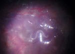 Thumbnail of Intraoperative fundus image depicting a migrating hookworm (Ancylostoma ceylanicum) ≈10 mm in length in the subretinal space of the eye of 10-year-old patient in Germany. 