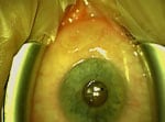 Thumbnail of Surgical extraction of a 13-cm worm from the eye of a patient with Dirofilaria repens infection.