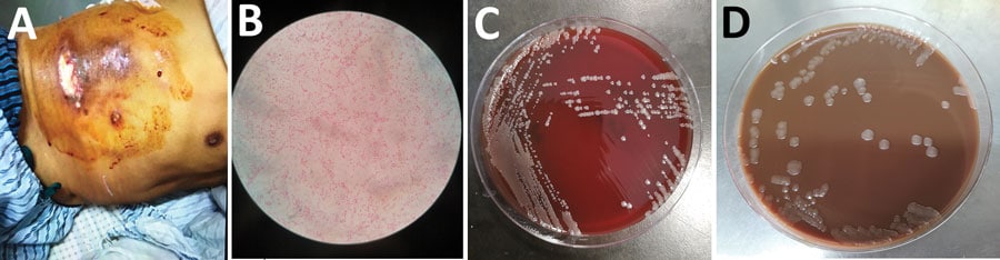 Chest wound of a 64-year-old male fisherman and isolated bacteria morphology, China. A) Ulcer and necrosis in the lower chest. B) Gram-negative cocci isolated from blood and wound. C) Growth on blood agar after 5 days with CO2. D) Growth on chocolate agar after 5 days with CO2.