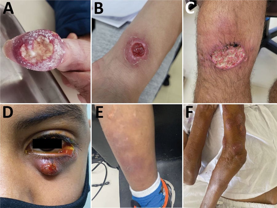 Unusual clinical manifestations of cat-transmitted sporotrichosis in patients treated at Hospital de Clínicas, Federal University of Paraná, Curitiba, Brazil, 2011–May 2022. A) Fixed cutaneous manifestation in the thumb with osteoarticular involvement. B) Fixed cutaneous manifestation in forearm with ulcer similar to primary cutaneous leishmaniasis. C) Lymphocutaneous manifestation in the knee with a large ulceration, mimicking cutaneous leishmaniasis. D) Ocular form with Parinaud ocular-glandular syndrome and dacryocystitis. E) Erythema nodosum resulting from immunoreactive sporotrichosis manifestation in the leg (same patient from panel D). F) Cutaneous disseminated manifestation in immunocompromised patient. 