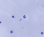 Pericardial fluid smear collected for diagnosis of acute Chagas disease among military personnel, Colombia, 2021. Giemsa-stained pericardial fluid smear of patient 1 shows a Trypanosoma cruzi parasite (center). Original magnification ×1,000.