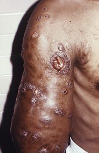 Actinomycetoma of the right upper arm caused by Nocardia brasiliensis