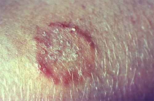 Photograph depicted a wheal-shaped, cutaneous lesion, commonly referred to as ringworm.