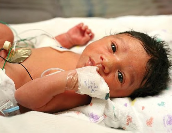 Photo: Premature infant
