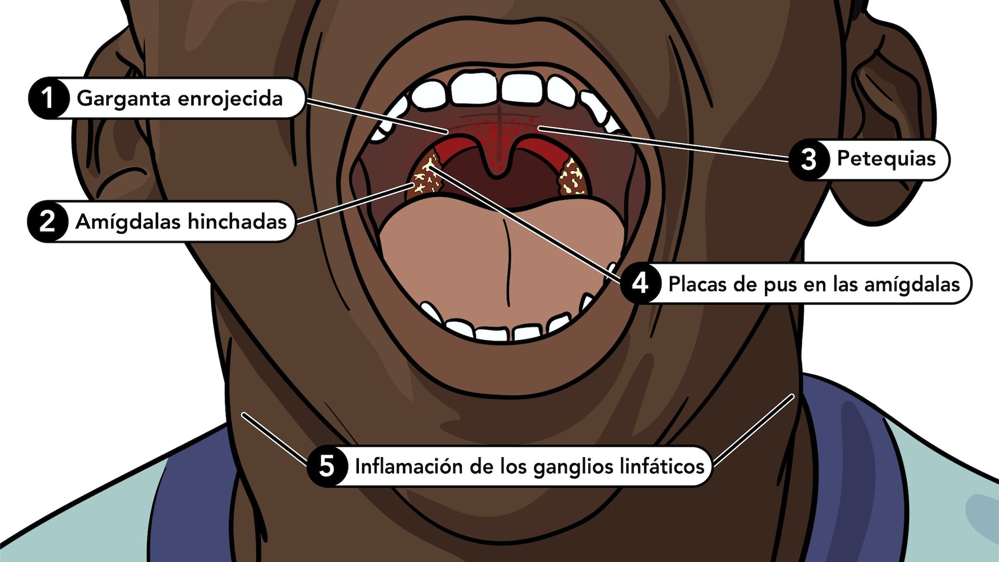 Primer plano de la boca de un niño con etiquetas en la lengua y garganta.