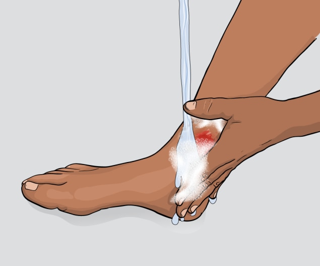 persona limpiándose una herida abierta en la pierna lavándola con agua y jabón