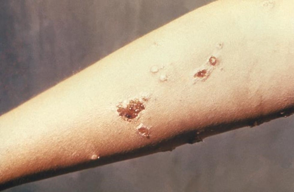 forearm lesions caused by S. pyogenes