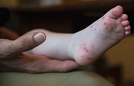 Mother holds child's foot and shows a rash of red spots.