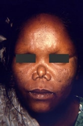 female patient exhibited some of the complications associated with multibacillary leprosy