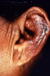 patient presented to a clinical setting with an inflammatory lesion on the outer left ear