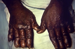 dorsal surface of the hands of a patient with a case of nodular multibacillary leprosy