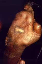 ventral surface of the right hand of a patient with a case of multibacillary leprosy