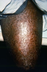 patient who had presented to a clinical setting with a case of multibacillary leprosy
