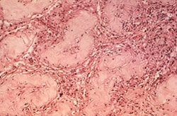 photomicrograph reveals some of the histopathologic changes in a specimen of human testicular tissue