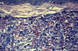 acid-fast-stained photomicrograph of a tissue sample extracted from a patient
