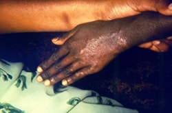 clinical setting with an active cutaneous lesion on the left hand,