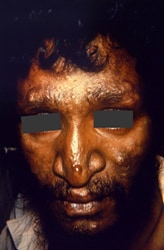 face of this male patient exhibited some of the pathologic characteristic associated with a case of nodular lepromatous, or multibacillary (MB), Hansen’s disease