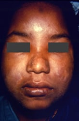 young woman presented with a case of borderline Hansen’s disease