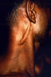 patient presented to a clinical setting with a marked enlargement of the great auricular nerve due to infection 