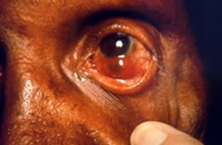 patient presented in a clinical setting with a case of multibacillary leprosy