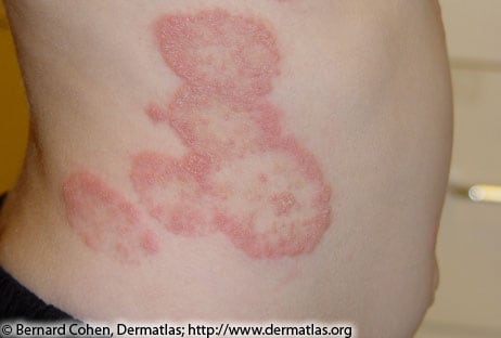 Rash on chest and back in children - RightDiagnosis.com