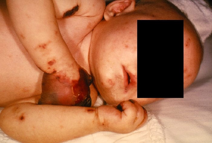 Close-up of an infant with gangrene on her hand laying on a bed.