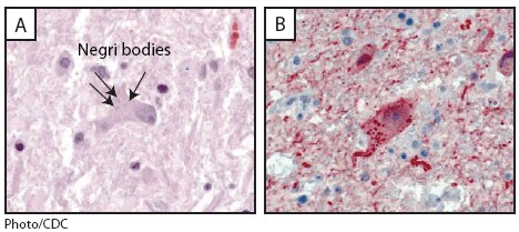 The figure shows photos from a histopathologic examination of central nervous system tissue from the autopsy of a decedent with suspected rabies infection in Indiana during 2009, showing neuronal cytoplasmic inclusions (Negri bodies) after hematoxylin and eosin staining and rabies virus antigen after immunohistochemical staining.