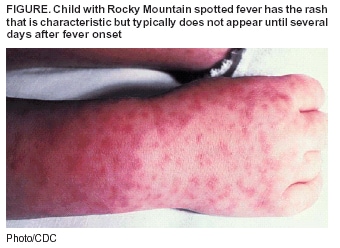 rocky mountain spotted fever symptoms