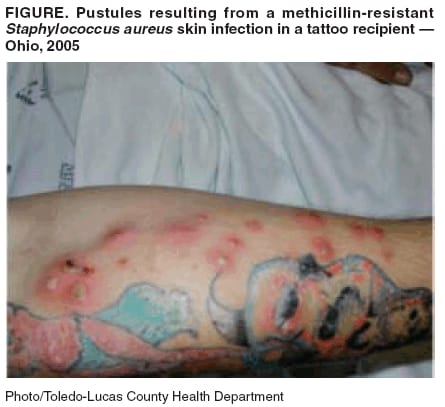 Skin Infections Among Tattoo Recipients --- Ohio, Kentucky, and Vermont, 