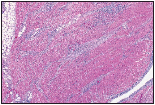 The figure above shows Hematoxylin and eosin stain, demonstrating interstitial perivascular lymphoplasmacytic pancarditis in postmortem tissue of one of three patients whose death was associated with Lyme carditis in the United States in 2012.