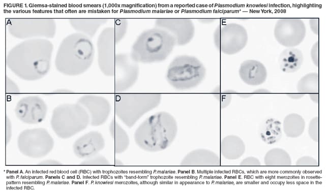 FIGURE 1. Giemsa-stained blood smears (1,000x magnification) from a reported case of Plasmodium knowlesi infection, highlighting the various features that often are mistaken for Plasmodium malariae or Plasmodium falciparum*  New York, 2008