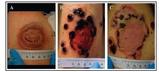 The figure shows three photographic images of a progressive vaccinia lesion in a military smallpox vaccinee. The photos were taken on March 5, March 27, and April 27, 2009, respectively.