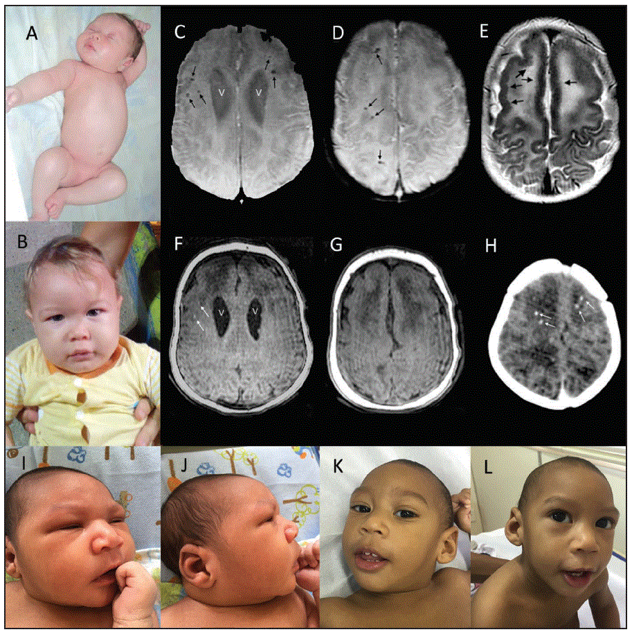 m6547e2f.gif The figure above is a composite of clinical photographs, magnetic resonance, and computed tomography images of two infants with congenital Zika syndrome in Brazil during October 2015–Octoboer 2016.