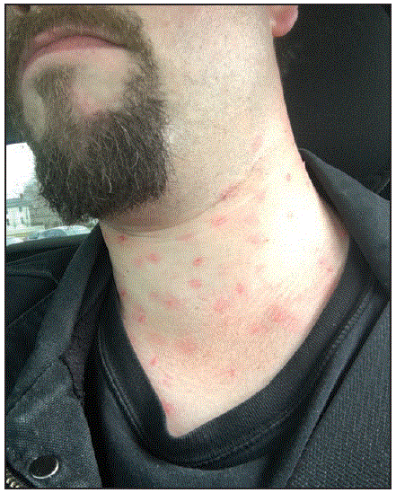 The figure above is a photograph showing a patient actor displaying a moulage-simulated measles rash in mystery patient drills in New York City during December 2015–May 2016.