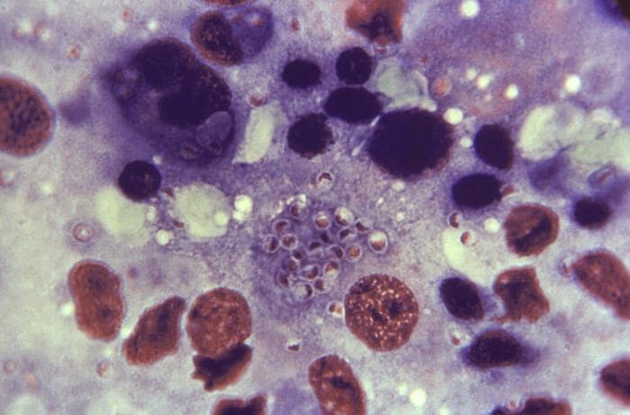 A micrograph of a liver tissue sample shows many small, round yeast cells as a result of histoplasmosis.