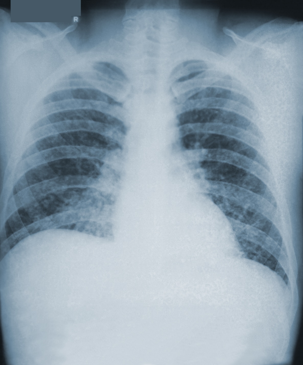 A chest x-ray of a patient with histoplasmosis shows thin thready areas in the lungs