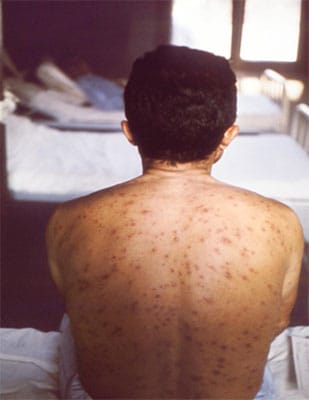 Chickenpox rash on back