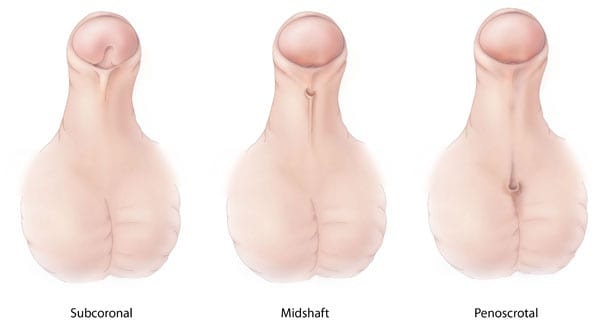 Types of Hypospadias - Subcoronal, Midshaft, and Penoscrotal