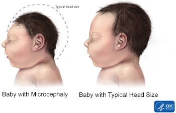 Microcephaly versus normal size head comparison