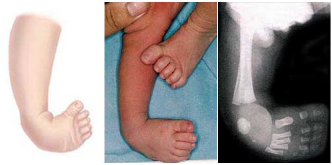Congenital deformities of feet