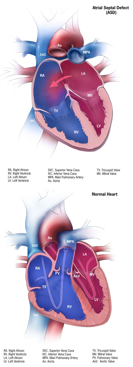 Normal Heart and Atrial Septal Defect