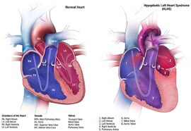 Imagen del sÃ­ndrome de corazÃ³n izquierdo hipoplÃ¡sico y de un corazÃ³n normal 